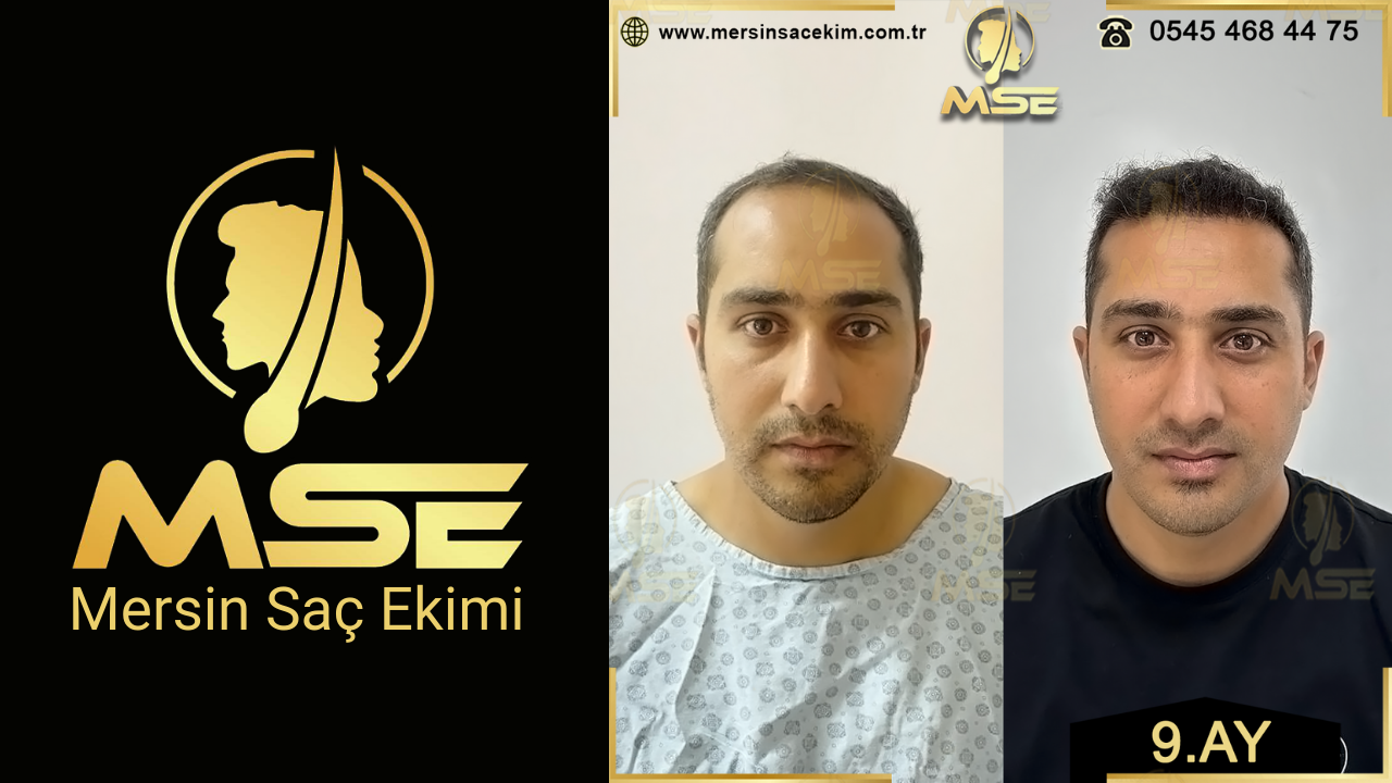 Mersin Saç Ekimi